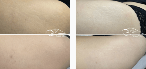 STRETCH MARKS REMOVAL