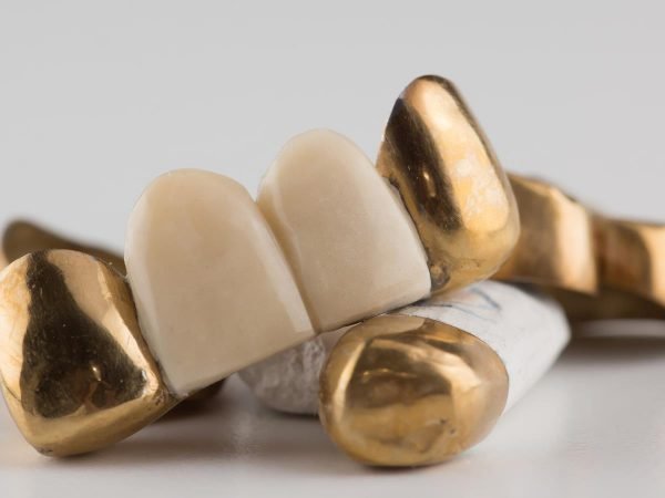 Five Things You Should Know About Dental Bridges