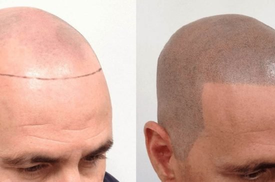 Scalp Micropigmentation